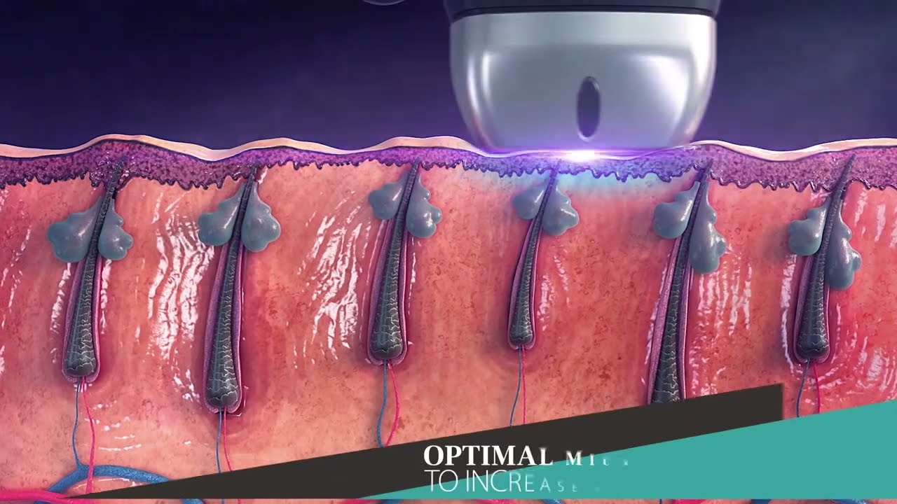 SHR 3D Technology - Soprano laser hair removal