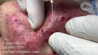 Dermatologist,squeeze pimples,whitehead blackhead, pustule,anti acnes|Vimpire acnes long video 2