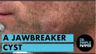 A Jawbreaker Epidermoid Cyst