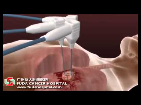 Cryotherapy | Cryosurgery | Cryo-ablation fuda cancer hospital