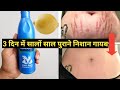 3 दिन में पुराने से पुराने स्ट्रेच मार�