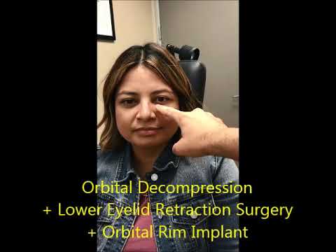 Orbital Decompression Surgery for Graves Disease Orbital Decompression Surgery for Graves Disease