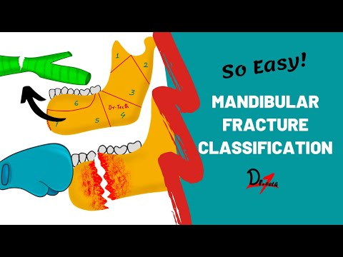 Mandibular Fracture Classification