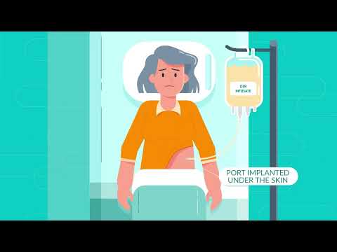 The alfapump DSR® system - combines Sequana Medical’s breakthrough DSR therapy with its alfapump®