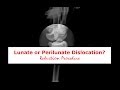 Lunate or Perilunate Dislocation?