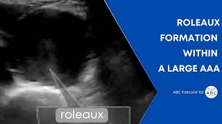 VASCULAR ULTRASOUND: Rouleaux formation in an abdominal aortic aneurysm