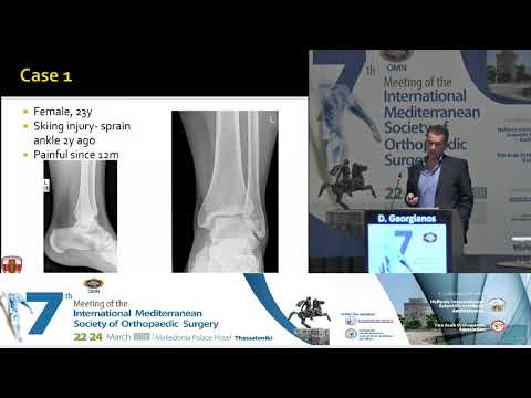 D Georgiannos - Osteochondral lessions of the talus. Surgical treatment