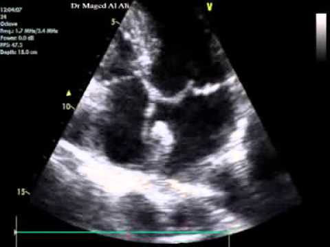 Left Atrial Myxoma