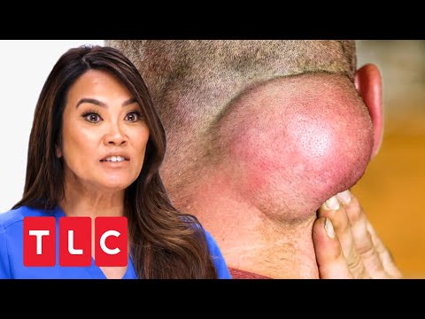 A tumor in the neck! | Dr. Pimple Popper | TLC Germany