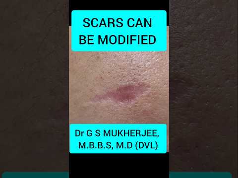Scar treatment on face #drgsmukherjee #co2laser #dermatologist #laserclinic