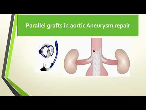 Case-Based Discussion: Brachial Access for Complex Aortoiliac Disease - Munier Nazzal, MD
