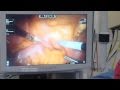Da Vinci Robot Surgery at East Kent Hospitals 