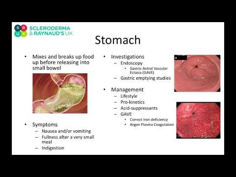 Dr Elizabeth Harrison talks about the Stomach in scleroderma