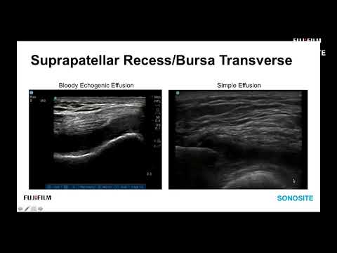Webinar: Ultrasound Evaluation of the Anterior Knee