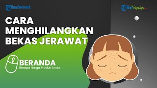 Cara Menghilangkan Bekas Jerawat dengan Mudah, Cukup Pakai 5 Bahan Alami Ini Dijamin Ampuh