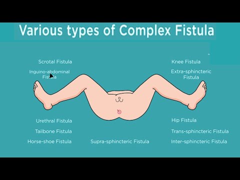 Anal Fistula Can Be Cured With DLPL. Everything You Need To Know From India’s Top Fistula Expert