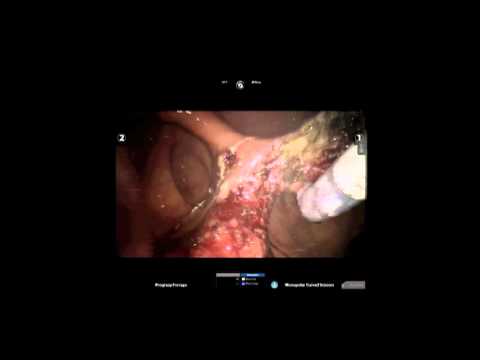 Robotic Assisted Single Incision Transgastric Resection Of 5 Centimeter Gastric Mass