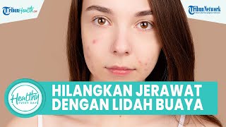 Cara Ampuh Hilangkan Bekas Jerawat dengan Bahan Alami, Begini Takaran Tepat Pakai Lidah Buaya