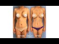 Dramatic Before And After Breast Revision Results To Repair Severe Stage IV Capsular Contracture