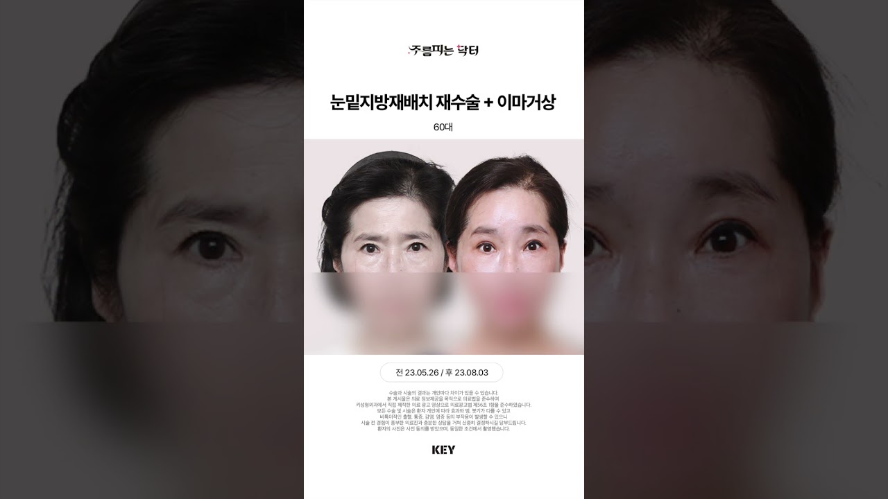 대구 이마거상 60대 대구키성형외과