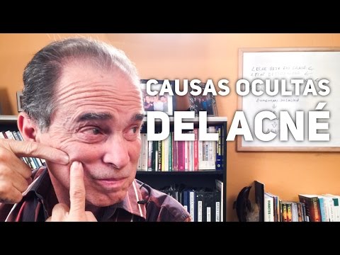 Episodio #1149 Causas Ocultas Del Acné