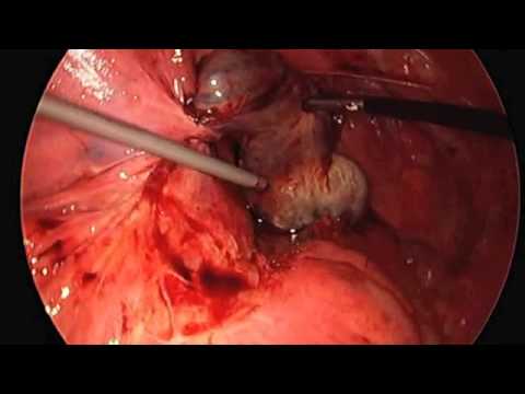 Laparoskopische Oophorektomie wegen einer Ovarialtorsion