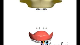 Overdenture com barra clipe