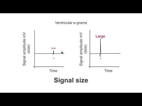 Pacemaker sensing and fixed sensitivity.