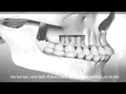 Oral and Maxillofacial Surgery Hyderabad | Best Dental Clinic Telanagana