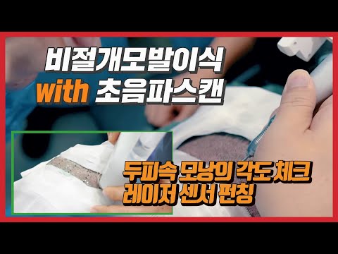 使用提高非切开毛发移植生存率的超声波扫描激光传感器穿孔的根毛发移植