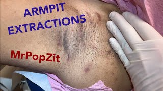 Armpit extractions. Clearing blackheads and ingrown hairs. Multiple pockets of keratin expressed.