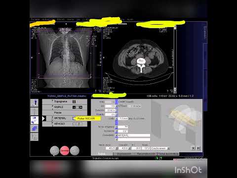 TOMOGRAFÍA MULTIDETECTOR DE TORAX S/C MULTIFASE, SIEMENS SOMATOM 6 CORTES.