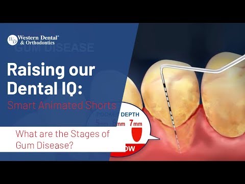What are the Stages of Gum Disease? | Western Dental