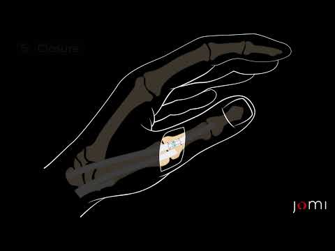 Thumb Extensor Tendon Laceration Repair