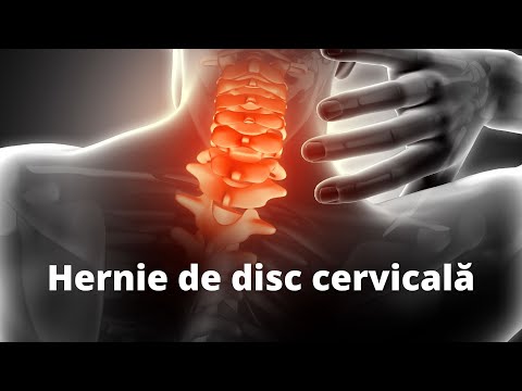 artroza tratamentului coloanei cervicale c5 c6 cum să tratezi osteoartrita acasă