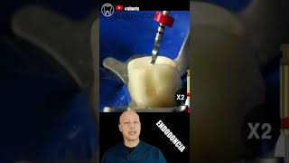 🔴SACAMOS el NERVIO de una MUELA COMPLETO #shorts #endodoncia #nerviodental