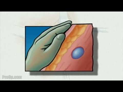 PreOp® General Biopsy Surgery