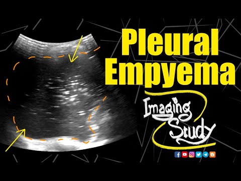 Pleural Empyema || Ultrasound || Case 156