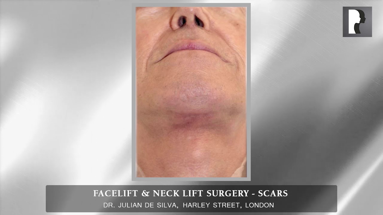 Natural Facelift & Neck Lift Surgery in London – Scars