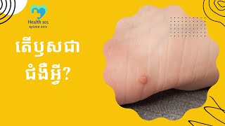 តើឫសជាជំងឺអ្វី? | ចំនេះដឹងសុខភាព​​​ | Health Education