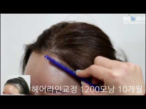 여성 헤어라인교정 1200모낭 10개월 후 Female Hairline Correction Surgery after 10 month - 1200grafts