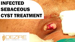 Infected Sebaceous Cyst Removal Under Local Anesthesia @dezireclinic