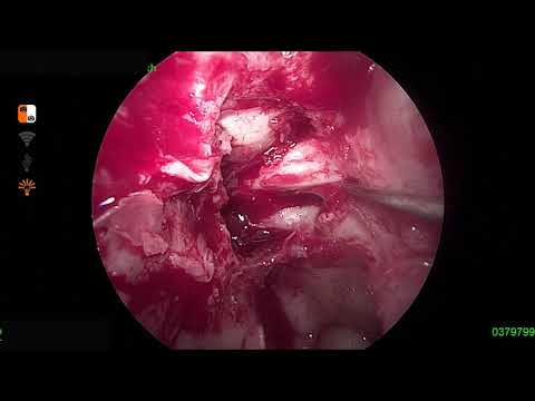 Endoscopic Optic Nerve Decompression | Acute Traumatic Optic Neuropathy