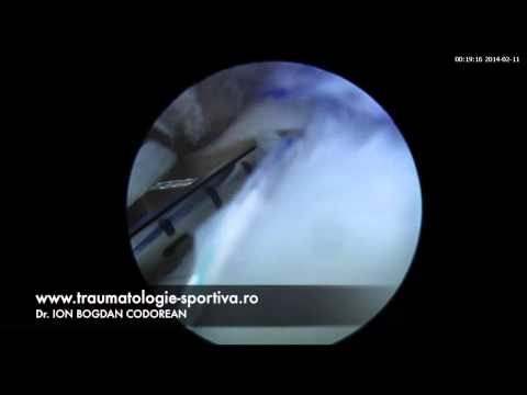 Sutură meniscală tip flap