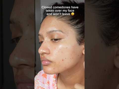 Closed comedones have officially taken over my face 😩 But what exactly are they?