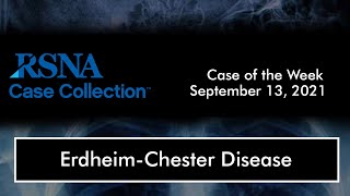 Case of the Week: Erdheim-Chester Disease