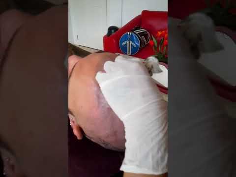 Scalp Micro Pigmentation Singapore