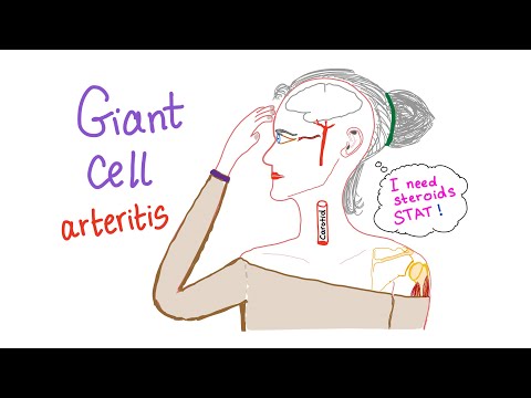 Giant cell arteritis (Temporal arteritis)
