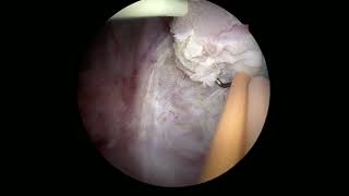 Core Videos (2025): En Bloc Transurethral Resection of Bladder Tumor
