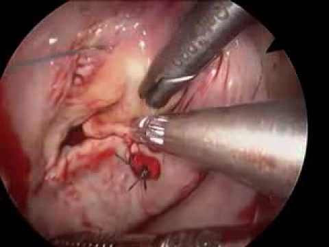 Mini Access Complex Mitral Valve Repair 